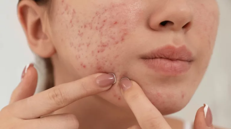 Roacutan: quem pode usar, quais os riscos e tudo que você precisa saber sobre o medicamento