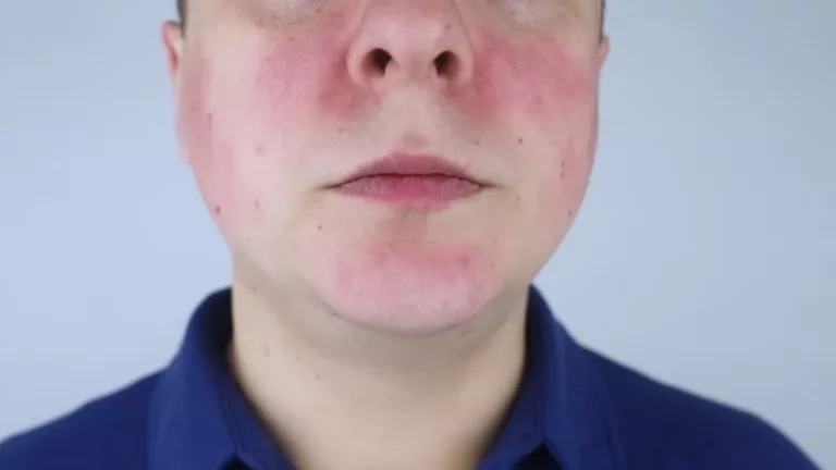 Rosácea no rosto: como identificar, cuidar e amenizar os sintomas da vermelhidão