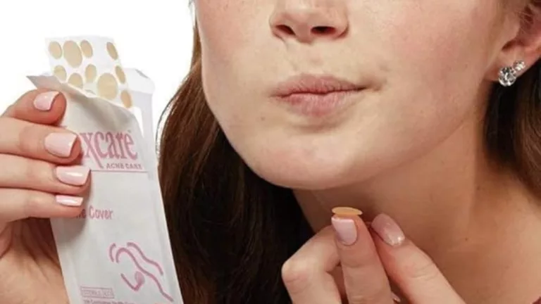 Curativo para acne: adesivo de R$ 35 promete secar e absorver espinhas
