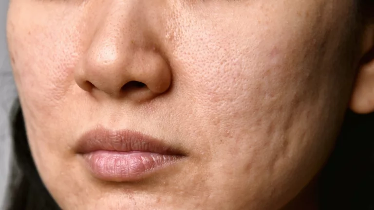 Os 3 produtos que realmente funcionam contra poros dilatados